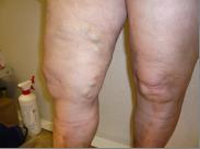 Gonglement, un symptome des pathologies veineuses