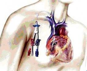 pose d un catheter