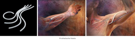 prothetische-fistels
